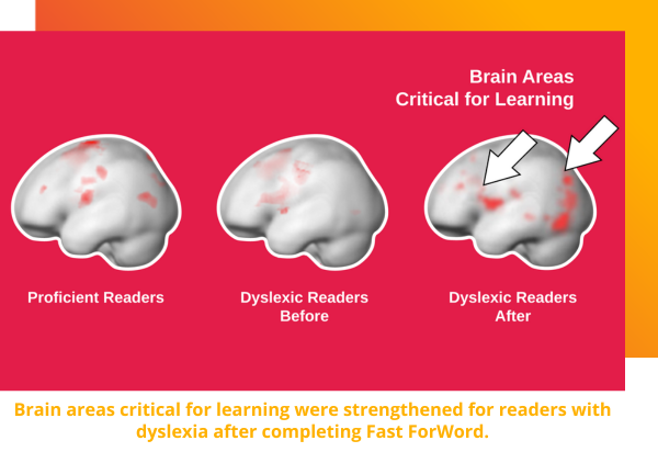 Brain scans of readers with dyslexia after using Fast ForWord